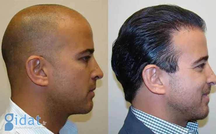 دلایل ریزش مو راهکارهای  درمانی